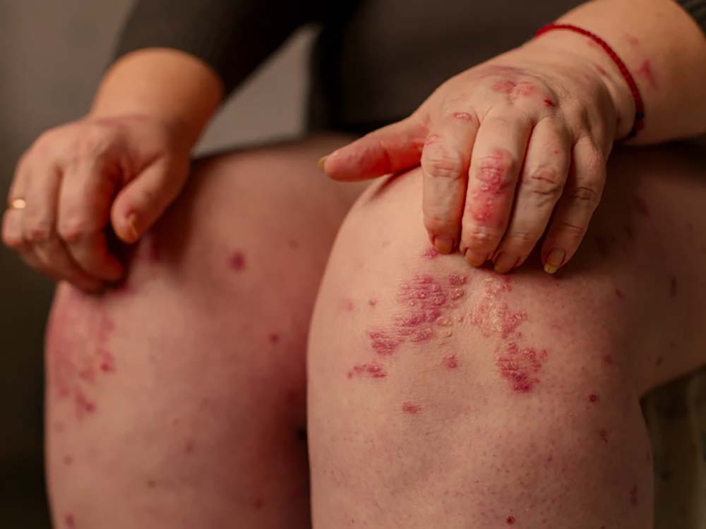 psoriaza-pogled
